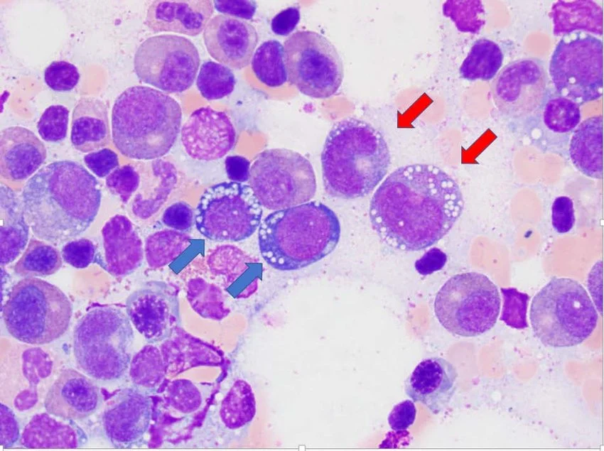 Bone marrow aspirate showing vacuolated precursor