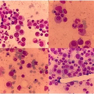 Bone marrow aspirate showing vacuolated precursor