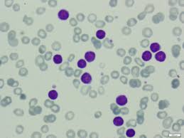 Lymphocytes on blood smear