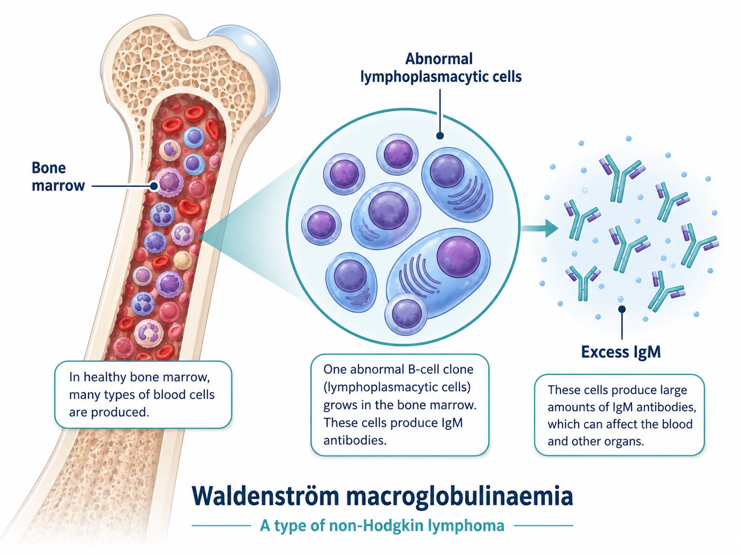 Diagram showing abnormal bone marrow cells producing excess IgM protein in Waldenström macroglobulinaemia.